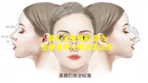 婴儿全身抽脂 婴儿全身湿疹大爆发怎么办